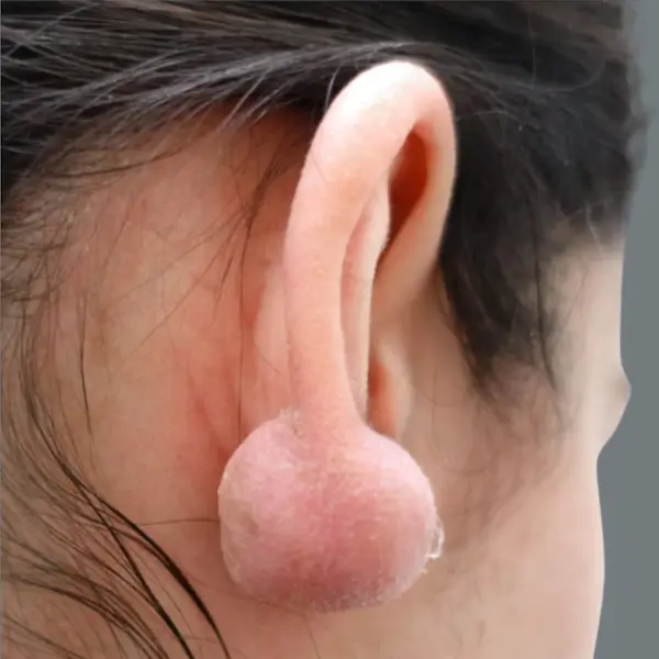 Ear keloid before treatment, back view