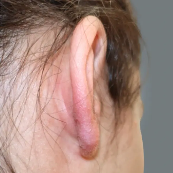 Ear keloid after treatment, back view