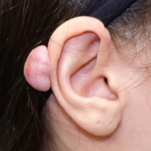 Ear keloid that developed after an ear piercing