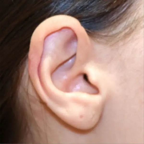 Ear after keloid excision and healing