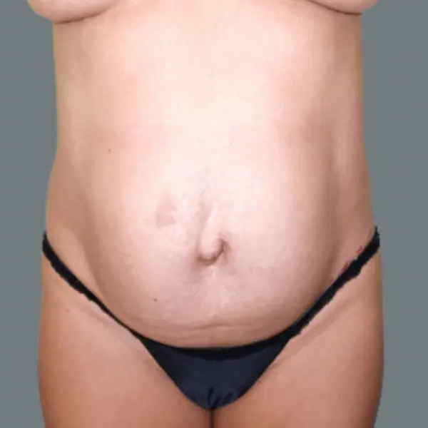 Before Abdominoplasty with Hernia/Diastasis Rectus Repair front view