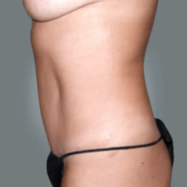After Abdominoplasty with Hernia/Diastasis Rectus Repair right side view