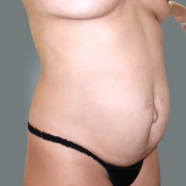 Before Abdominoplasty with Hernia/Diastasis Rectus Repair left oblique view