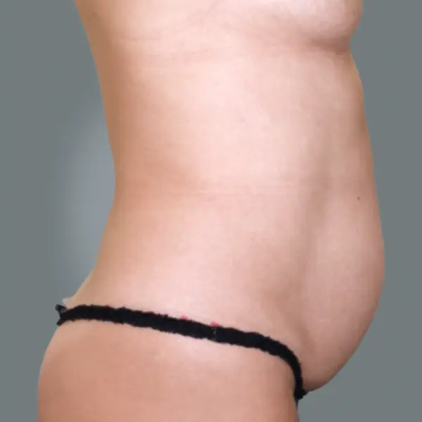 Before Abdominoplasty with Hernia/Diastasis Rectus Repair left side view