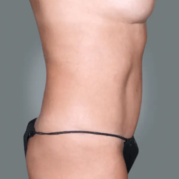 After Abdominoplasty with Hernia/Diastasis Rectus Repair left side view