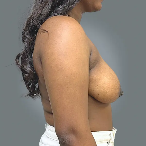 Before breast reduction left side view