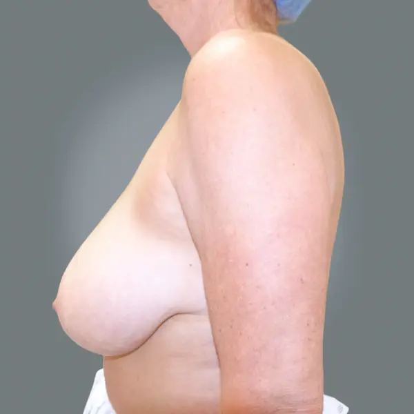 Before breast reduction right side view