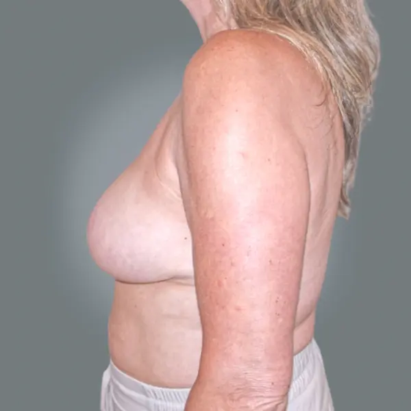 After breast reduction right side view
